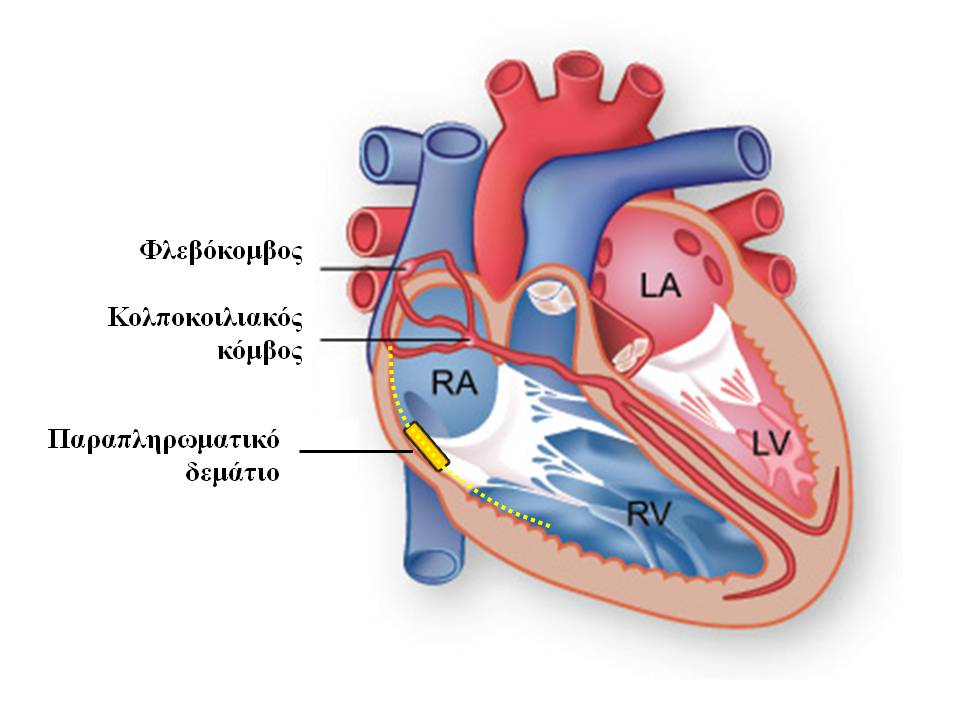 accessory-pathway image