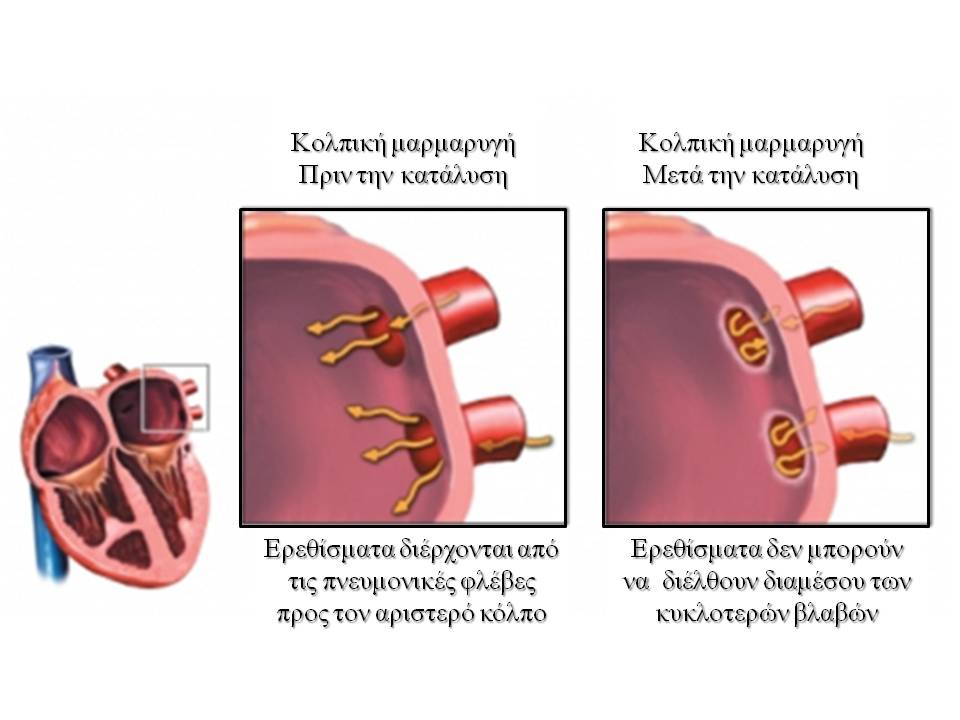 af-ablation image