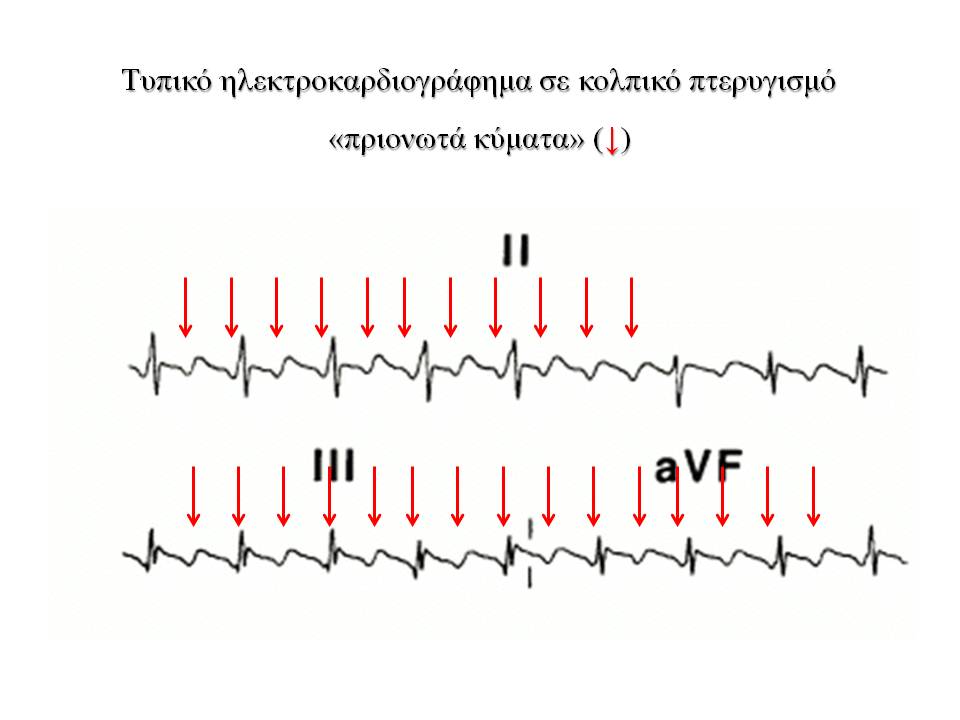 atrial-flutter image