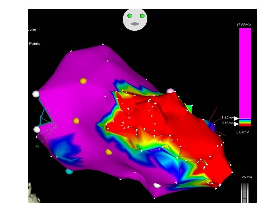 vt-ablation image